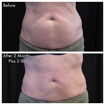 Abdomen before and after CoolSculpting