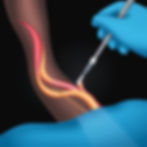How PAD Therapy Works (Part 1)__Under fluoroscopy guidance catheter is inserted into in th