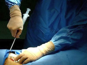 Ya hay siete pacientes que pueden recibir un trasplante de médula ósea en Mendoza