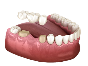 Dental-Bridges-768x576_edited.png