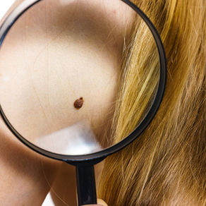 6 Signs You Should Get Your Mole Checked Out