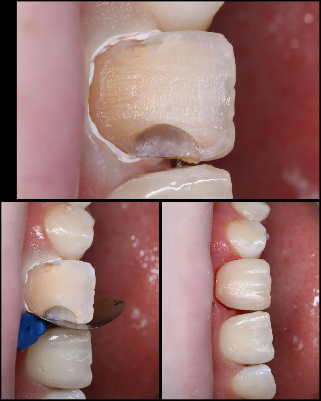 Лікування зубів на дому