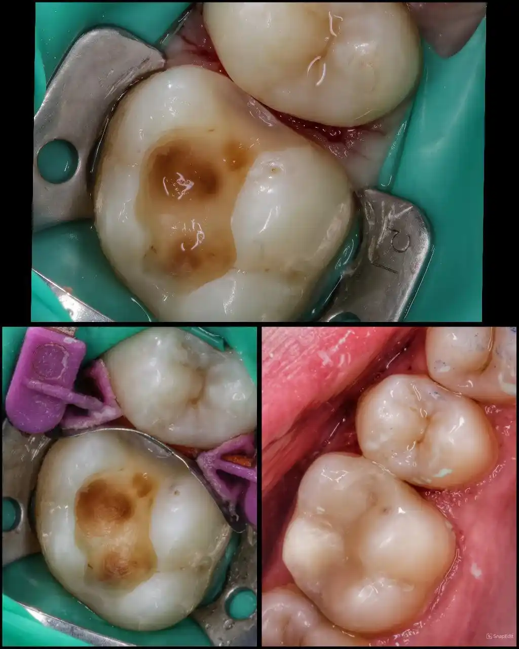 Лікування зубів на дому