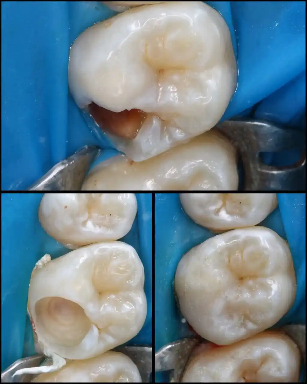 Лікування зубів на дому