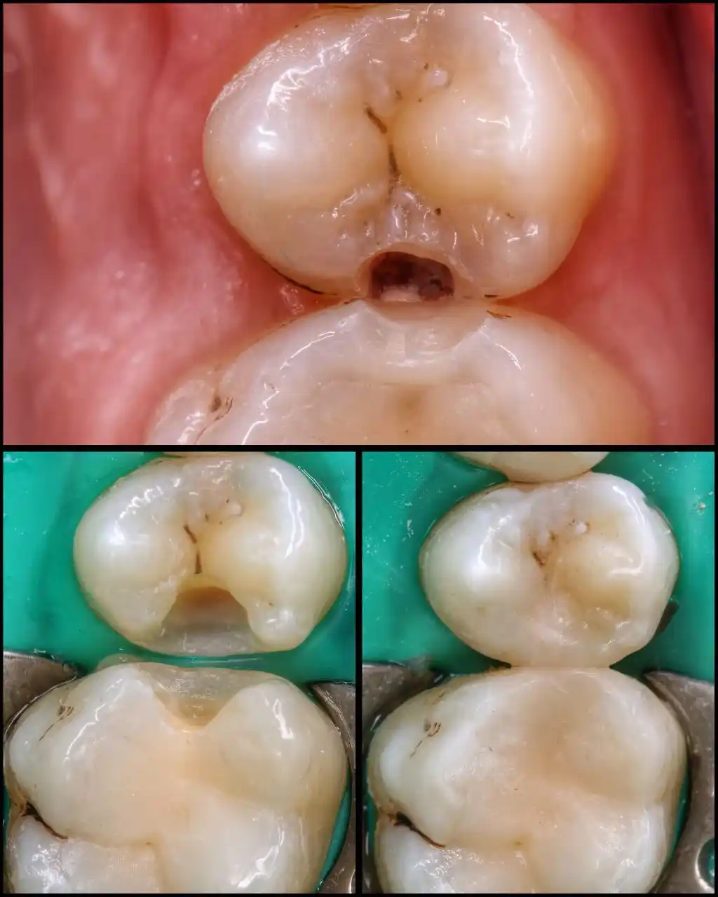 Лікування зубів на дому