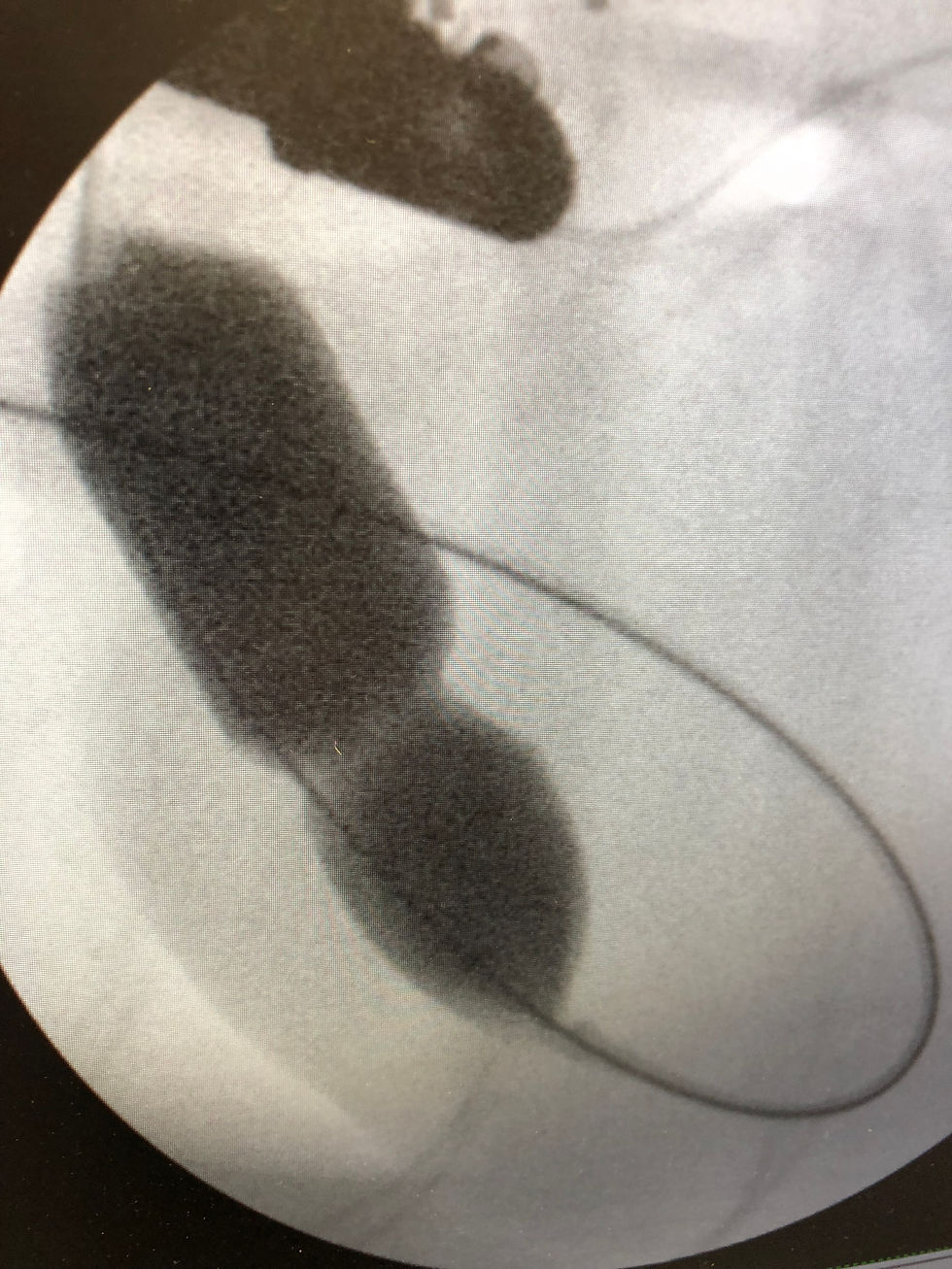 the blockage in Michael Pulmonary artery