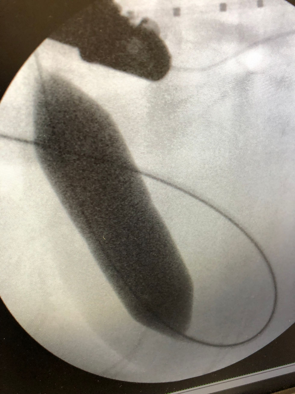 Michael's Pulmonary Artery after surgery