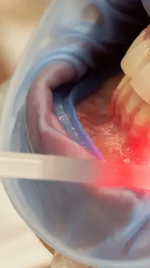Unveiling the Wonders of Red Light Therapy for Teeth and Gums