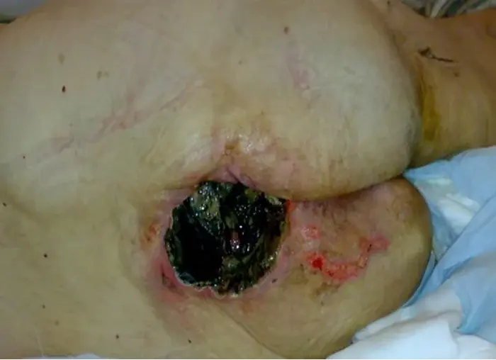 A Sacrum Pressure Sore
