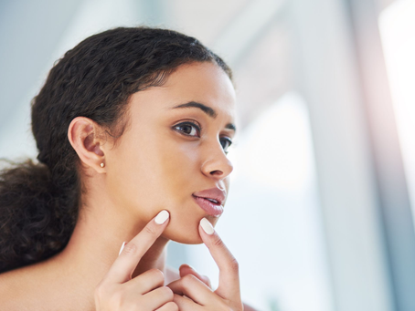 Say Goodbye to Acne with Natural Skincare: The Gentle, Safe, and Eco-Friendly Approach