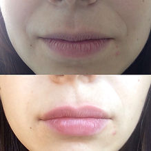 Aumento de labios, acido hialuronico, antes y despues