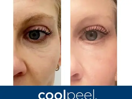 CoolPeel CO2 Laser Williamsburg VA