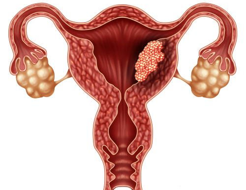 כמה מחקרים הראו כי קיים קשר גנטי מסוים בין סרטן הרחם לגיל האישה. אורן זריף