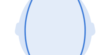 Diagram showing scaphocephaly in a newborn baby, highlighting the elongated head shape. Learn how gentle positioning can support healthy skull development.