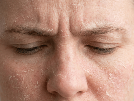 Sucha skóra na twarzy łuszcząca się płatami