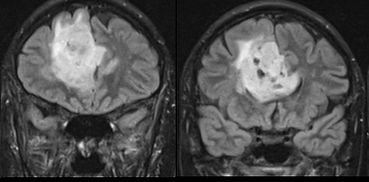 glioma. microsurgery. brain. craniotomy. intraoperative monitoring. mapping. plasticity. cingulate gyrus.
