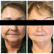 3 Microneedling Treatments