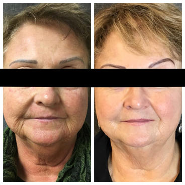 3 Microneedling Treatments