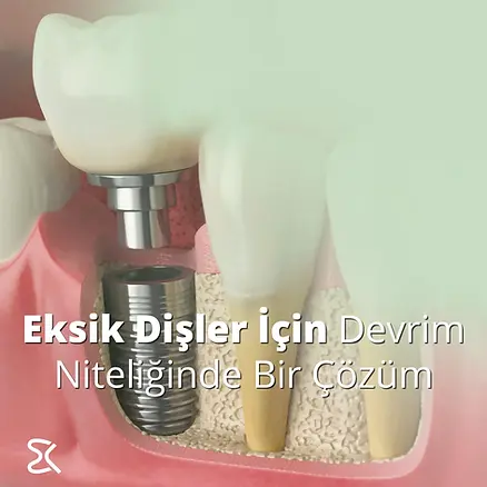 izmir'de en iyi implant yapan doktor