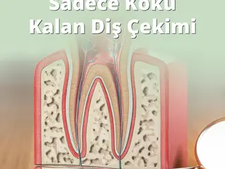 Sadece Kökü Kalan Diş Çekimi