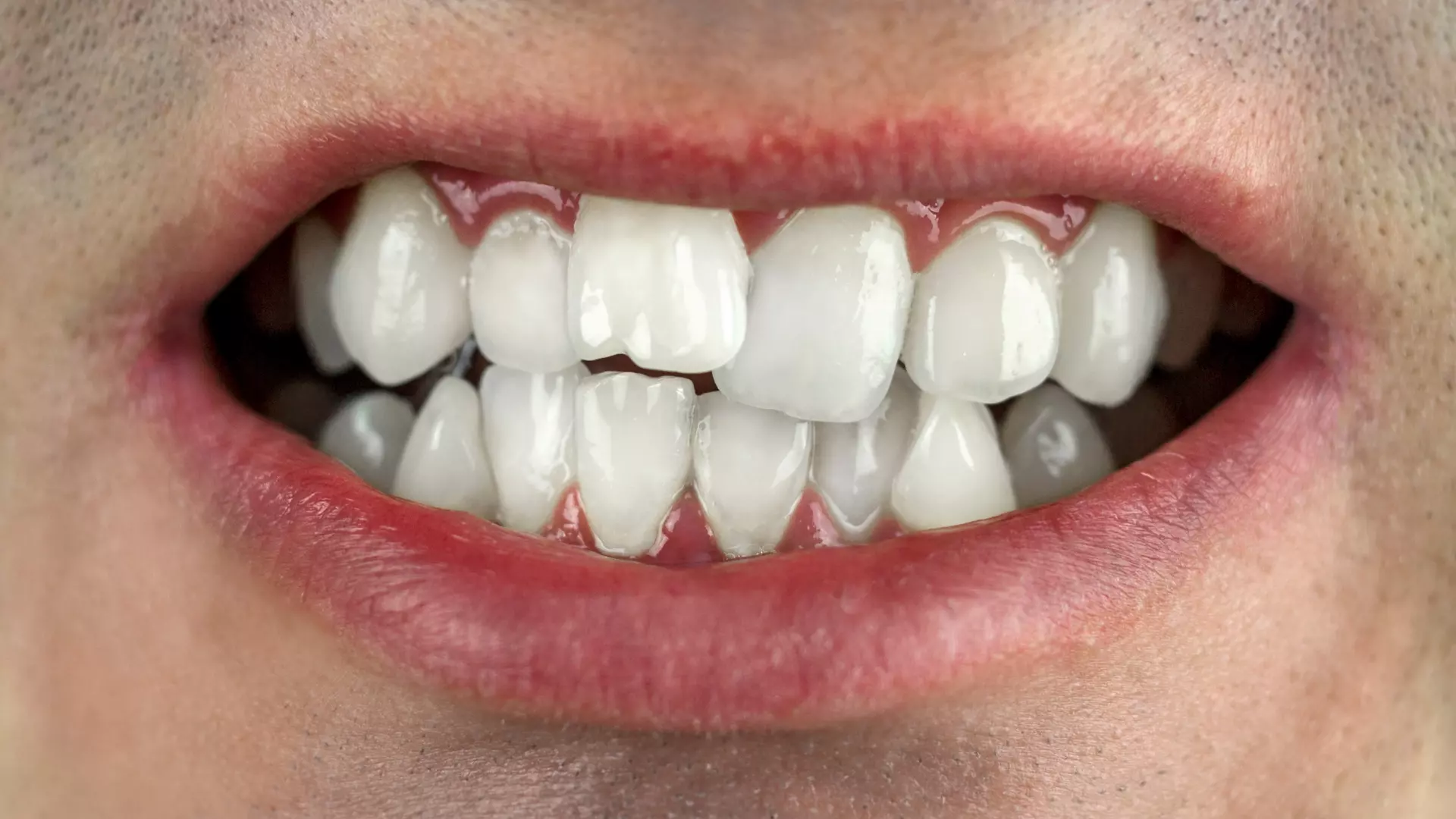 Orthodontics Teeth Braces Invisalign cost in Izmir Turkey