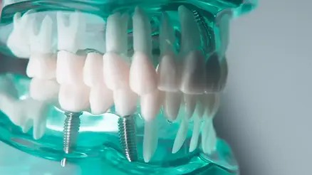 izmir de en iyi implant yapan doktor