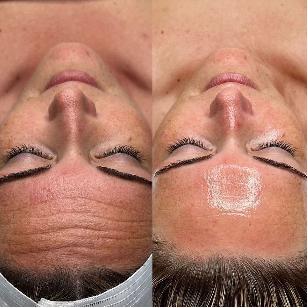 resultats avant apres jetpeel