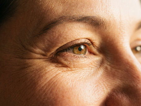 rides-autour-yeux-traitement-2