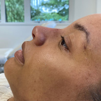 Rhinoplasty After