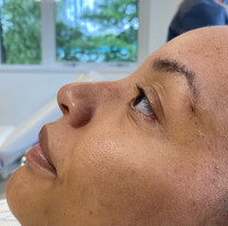 Rhinoplasty Before