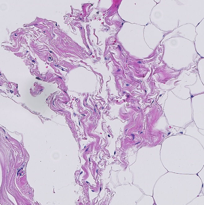 Fibrolipoma