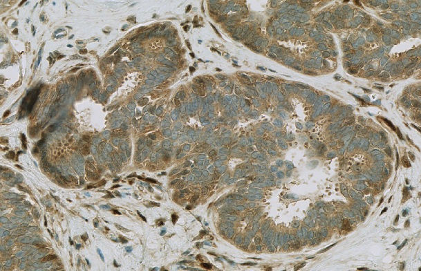 Adenocarcinoma