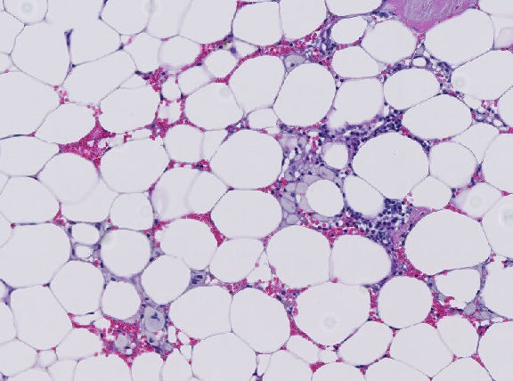 Lipoma