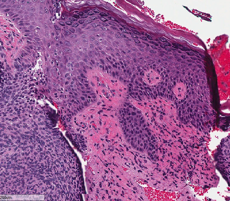 Carcinoma basocelular