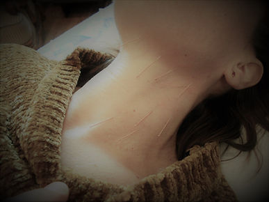 lifting acupuncture