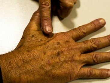 Dezembro Laranja: Câncer de pele é o mais comum no Brasil; saiba como evitar