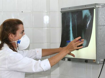 TUBERCULOSE: tratamento interrompido pode gerar formas mais graves da doença