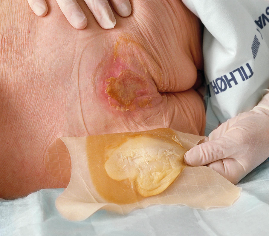 Bedsore with hydrocolloids