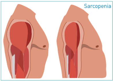 sarcopenia_illustration.png