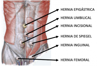 QUAISQUER HÉRNIAS ABDOMINAIS