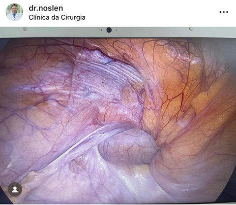 Visão Interna Orifício De uma Hérnia Inguinal