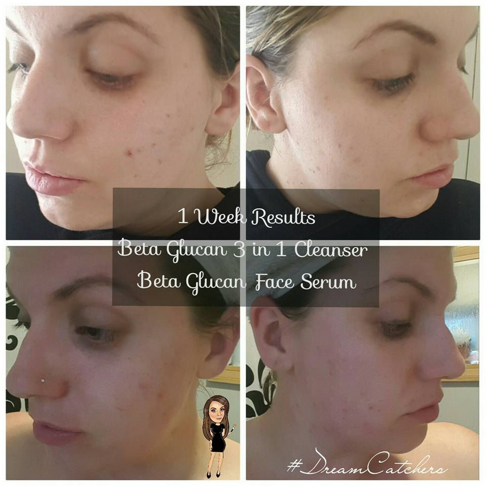 Our Beta Glucan range.. Results on acne!