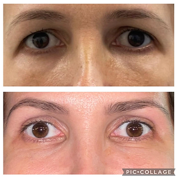 blefaroplastia_antes_depois_paciente_nova.jpeg.png