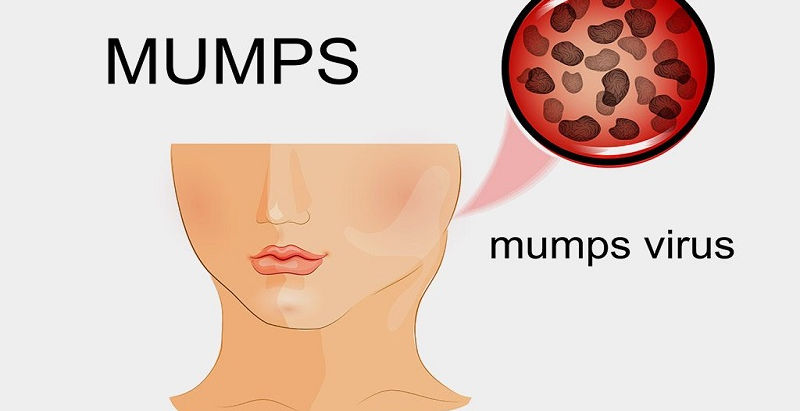 Bệnh Quai Bị Cần Kiêng Gì? Và Kiêng Bao Lâu?