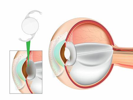 Medstock_Oftalmologia_Catarata_755849107 (1).jpeg