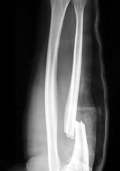 How not to climb a tree