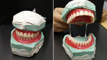 What are dentures? Why we need dentures? What are types of dentures?
What are benefits of dentures?