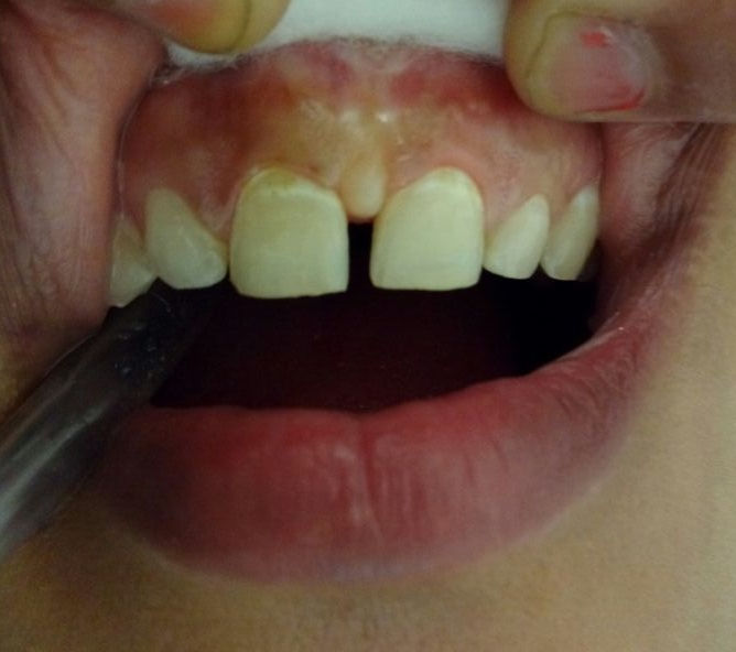 Smile Makeover Case Study 1 before treatment
