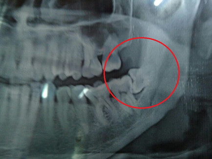 Surgical extraction of impacted wisdom tooth 38