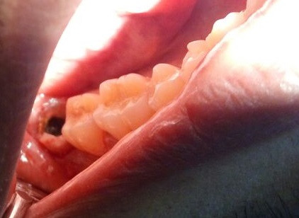 FIGURE 1. Pre-operative photograph of infected tooth area